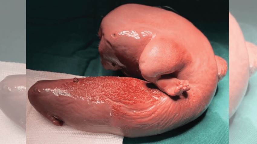 Raro caso de Fetus-in-fetu: gemelo malformado crece en el cerebro de una niña de 1 año
