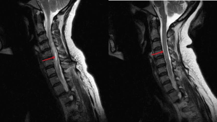 Puertorriqueña fue diagnosticada con neuromielitis óptica 15 años después de presentar hipo intratable