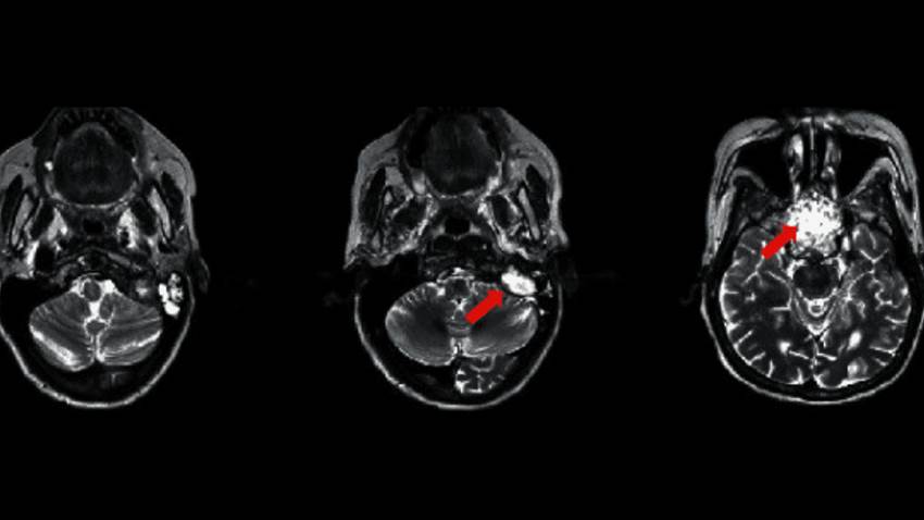 Mujer desarrolló metástasis en la cabeza por tumor primario de mama diagnosticado hace 23 años