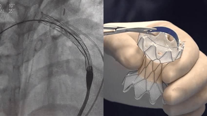 Paciente pediátrica con cardiopatía congénita recibe primer reemplazo de válvula pulmonar transcatéter