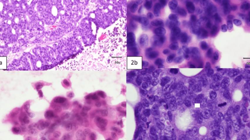 Extraño caso de adenocarcinoma de colon asintomático con metástasis al cerebro en hombre puertorriqueño
