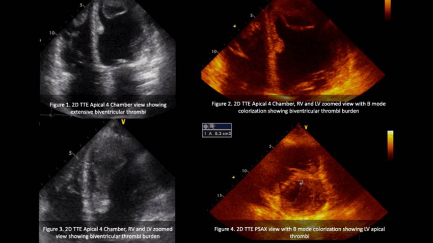 Mujer hispana diagnosticada con miocardiopatía periparto sufre complicación fatal
