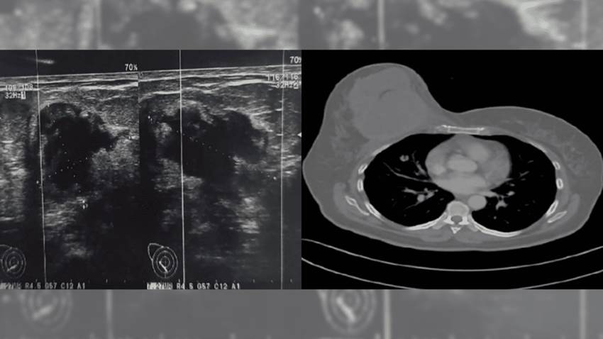 Enorme carcinoma metaplásico de mama invade pared torácica y hace metástasis en el pulmón