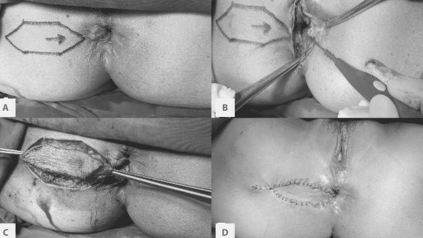 Reparación anal con colgajo de diamante en mujer de 57 años, tras dos años de cirugía hemorroidectomía