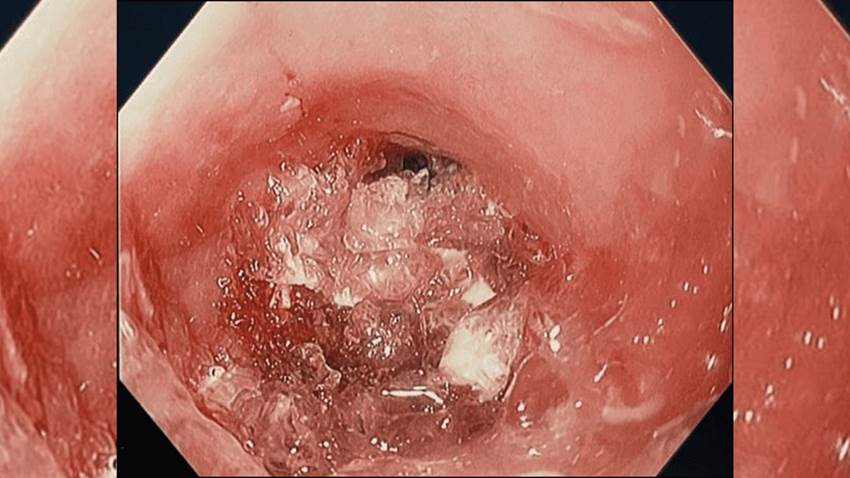 Mujer con esofagitis eosinofílica sufre atragantamiento al ingerir tres cápsulas de hidrogel