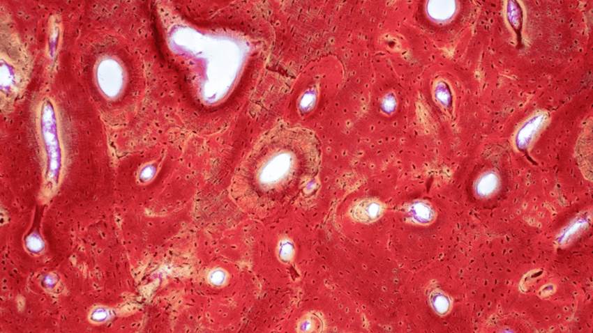 Intoxicación por vitamina D e hipercalcemia severa en paciente por mal uso de suplementos nutricionales