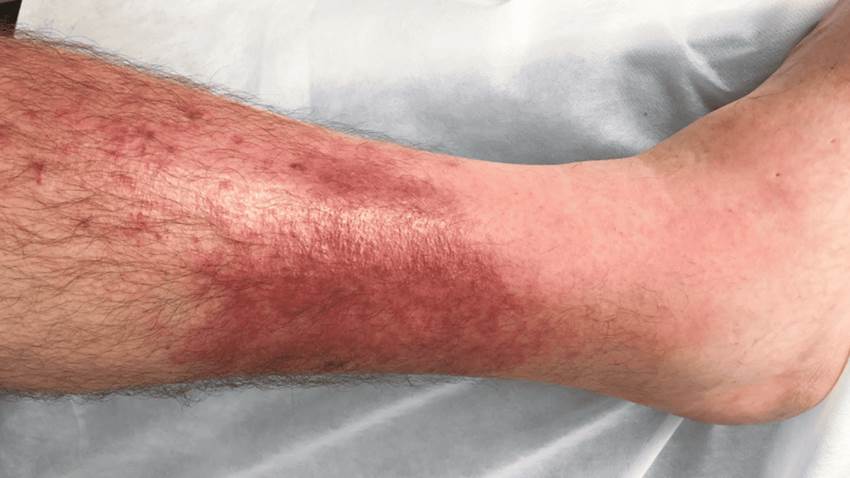 Relación entre linfedema, insuficiencia venosa y enfermedad vascular con recurrencia de la celulitis