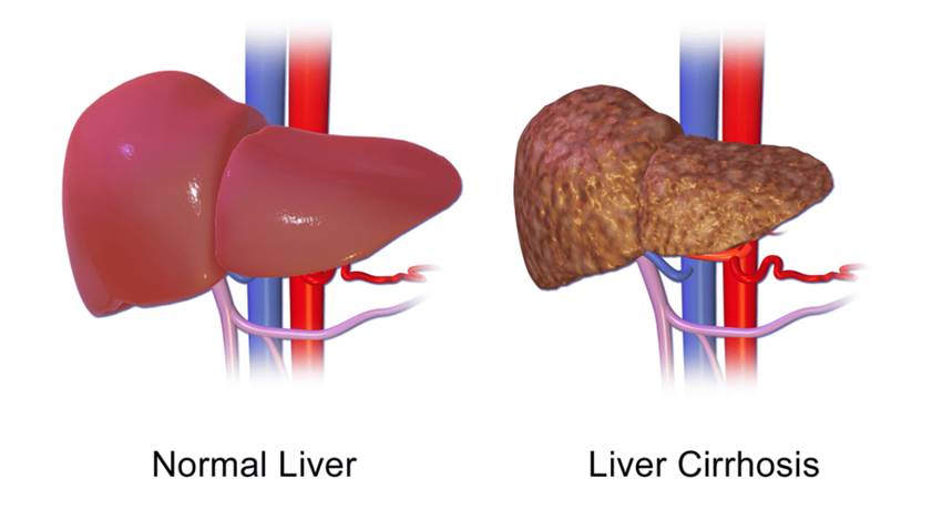 Estudio clínico ofrece oportunidad de tratamiento innovador a pacientes con cirrosis descompensada