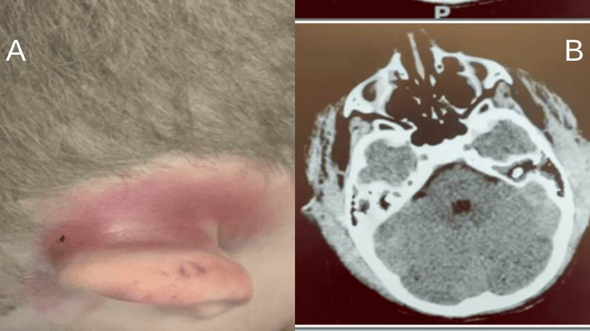 Paciente pediátrico presenta cefalea con hinchazón por raro hematoma subgaleal
