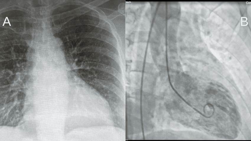 Mujer puertorriqueña de 59 años sufre una rara variante de miocardiopatía de Takotsubo