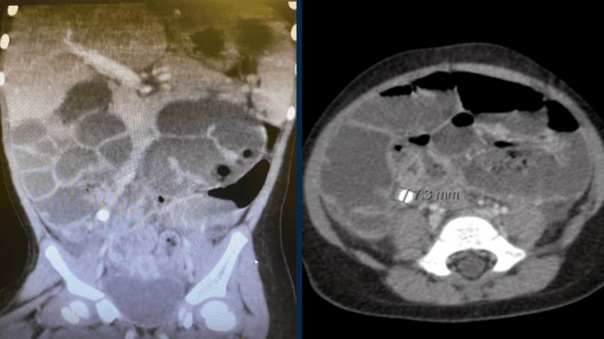 Paciente de 2 años presenta un atípico caso de apendicitis aguda perforada con peritonitis purulenta