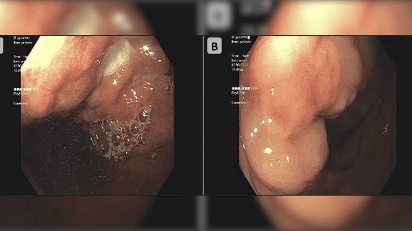 Extraño caso de metástasis en estómago y colon por inusual complicación de cáncer de mama