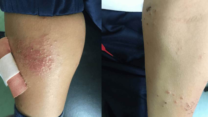 Paciente con dermatitis atópica desarrolla inusual infección cutánea causada por bacteria intestinal
