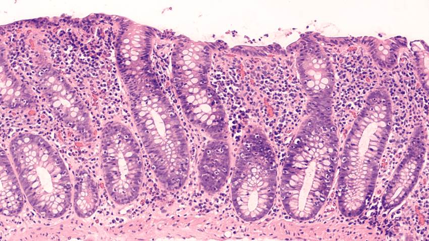 Colitis microscópica: la enfermedad intestinal difícil de detectar que más afecta a mujeres