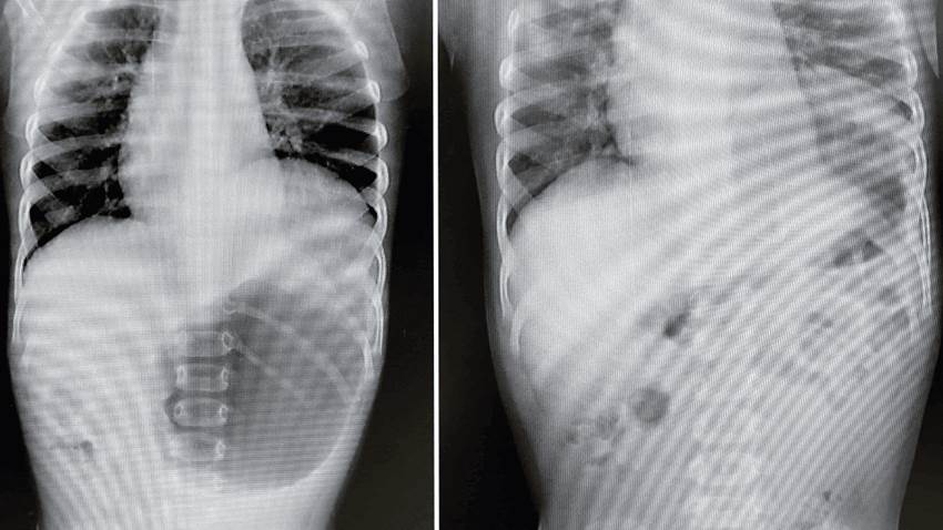 Médicos salvan a paciente pediátrico con hernia diafragmática y raro gastrotórax a tensión