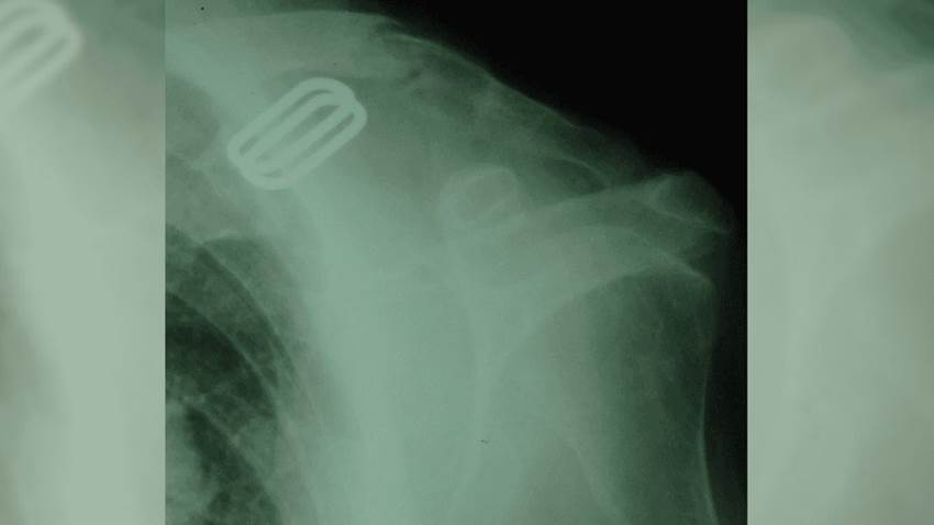 Adulta presentó fractura de clavícula espontánea multifactorial por estrés sin antecedentes traumáticos
