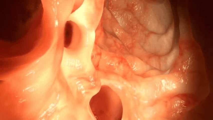 Tabaquismo y consumo de alcohol aumentan el riesgo de padecer diverticulitis