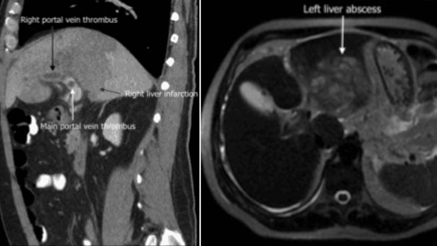 Paciente ingresado por infección de COVID -19 debutó con infarto hepático y trombosis de vena porta