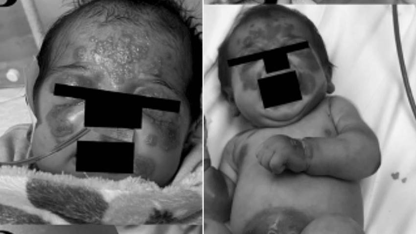 Niña de 3 años con fiebre recurrente y erupciones cutáneas es diagnosticada con Hipergammaglobulinemia D