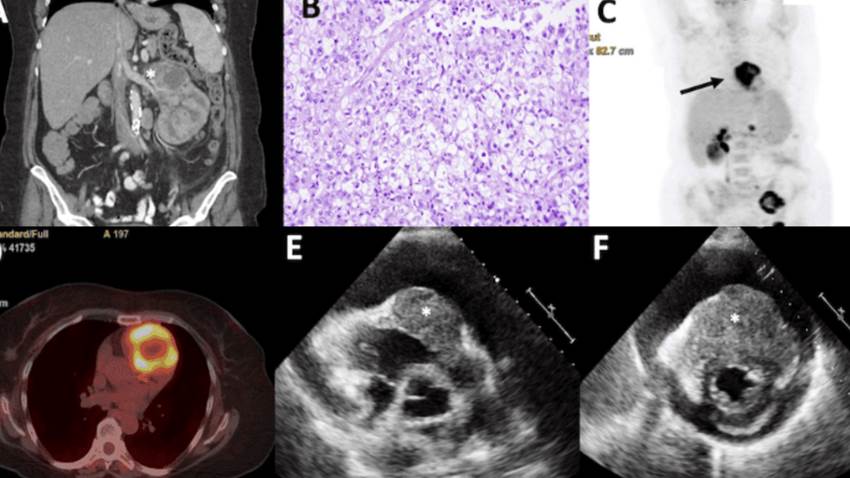Carcinoma renal con metástasis cardíaca en mujer de 52 años con disnea súbita y taponamiento cardiaco