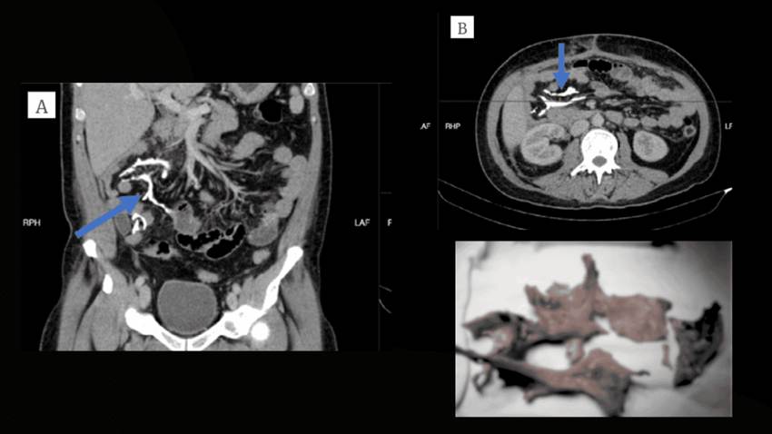 Detectan formación anormal de hueso en el mesenterio de un paciente con ileostomía durante una tomografía