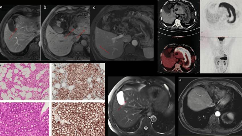 Dolor abdominal y diarrea revelan tumor neuroendocrino hepático en hombre de 70 años