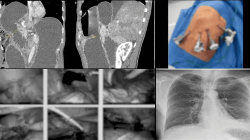 Hernia diafragmática no detectada tras accidente es reparada con cirugía robótica 7 años después