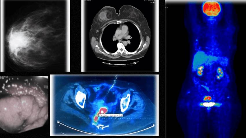 Detectan cáncer de mama y cáncer rectal simultáneos con reactivación de hepatitis B tras quimioterapia