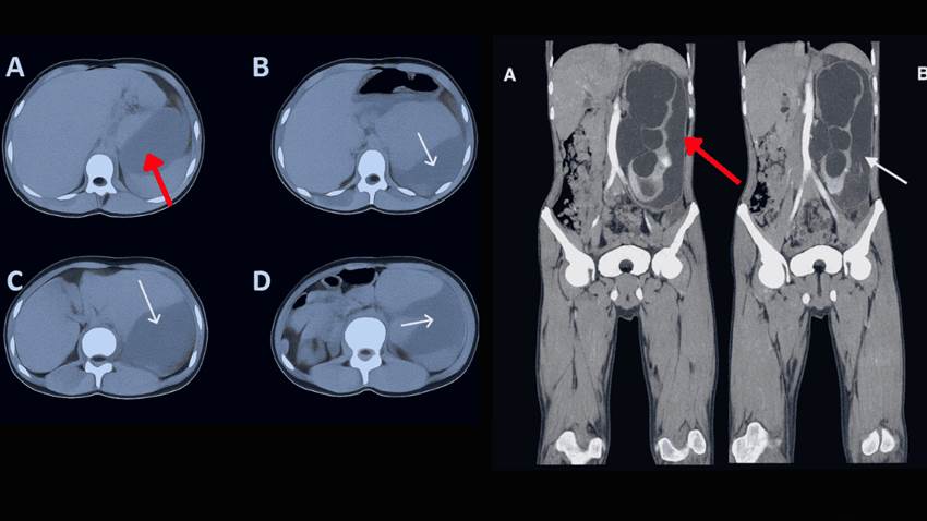 Rotura espontánea de riñón por obstrucción congénita se manifiesta con dolor lumbar, vómitos y fiebre