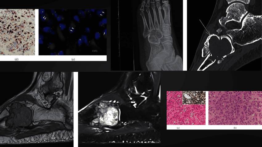 Tumor tenosinovial de células gigantes en huesos simuló histiocitosis en paciente con dolor e inflamación