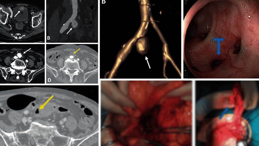 Detectan aneurisma micótico con fístula entre la arteria ilíaca y el colon en paciente con hematoquecia