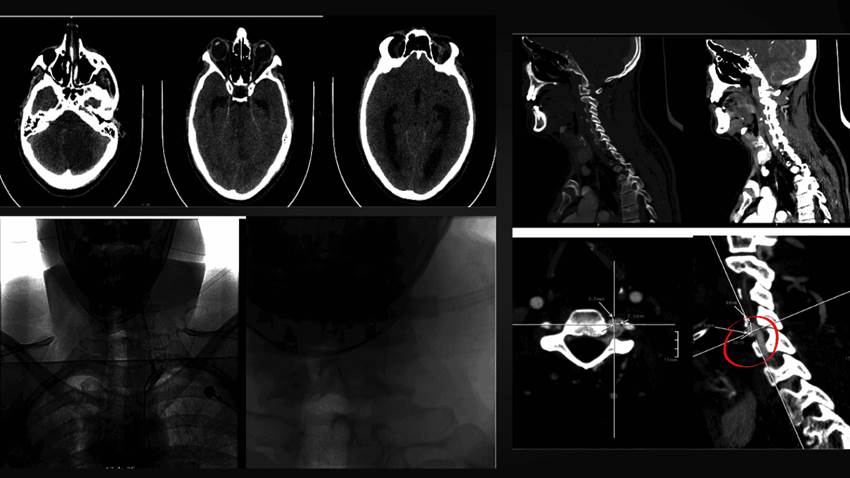 Joven con hematemesis sufre derrame cerebral isquémico tras herida de arma blanca en el cuello