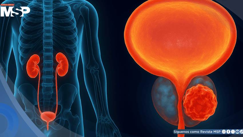Alternativa a la cirugía en cáncer de vejiga: TAR-200 libera quimioterapia sostenida con 82% de respuesta