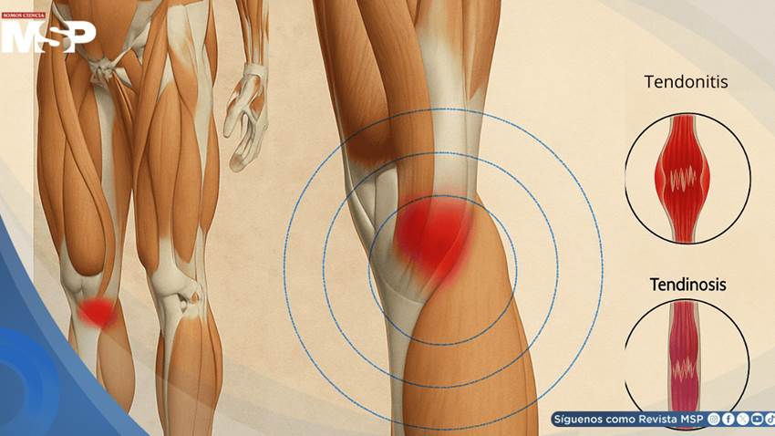 Tendinitis vs. tendinosis: diferencias, síntomas y tratamiento efectivo