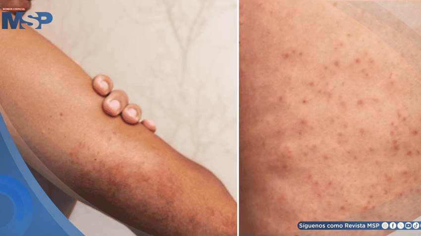 ¿Piel áspera y bultos en brazos o muslos? Descubre qué es la queratosis pilaris: causas, y tratamiento