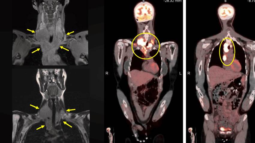 Masa cervical, fiebre y pérdida de peso como presentación de un linfoma de Hodgkin con carga viral