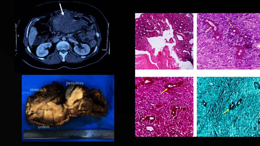 Basidiobolomicosis gastrointestinal es confundida con colitis ulcerosa en paciente con masa abdominal