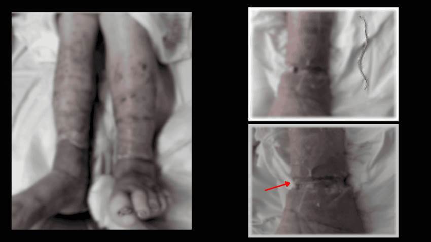 Banda elástica olvidada como causa de úlcera con necrosis en extremidad inferior de paciente con diabetes