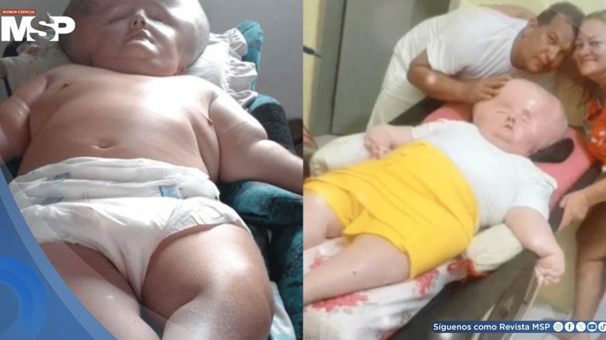 Madre mantiene viva a su hija con hidrocefalia y síndrome de rubéola congénita: Le daban 3 meses de vida