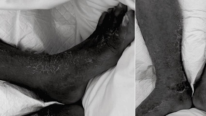 Bacteria marina causa infección en la pierna de un hombre de 75 años con diabetes y psoriasis