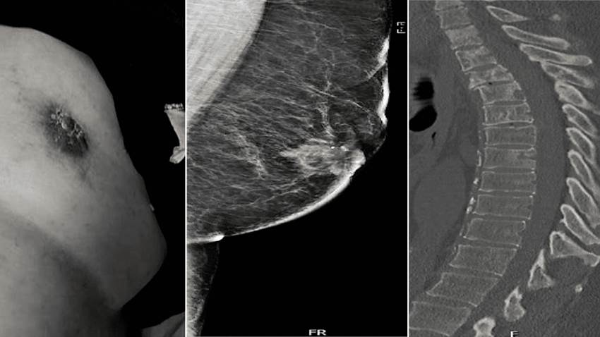 Paciente masculino fue diagnosticado con cáncer mamario avanzado: Dolor lumbar fue el síntoma inicial
