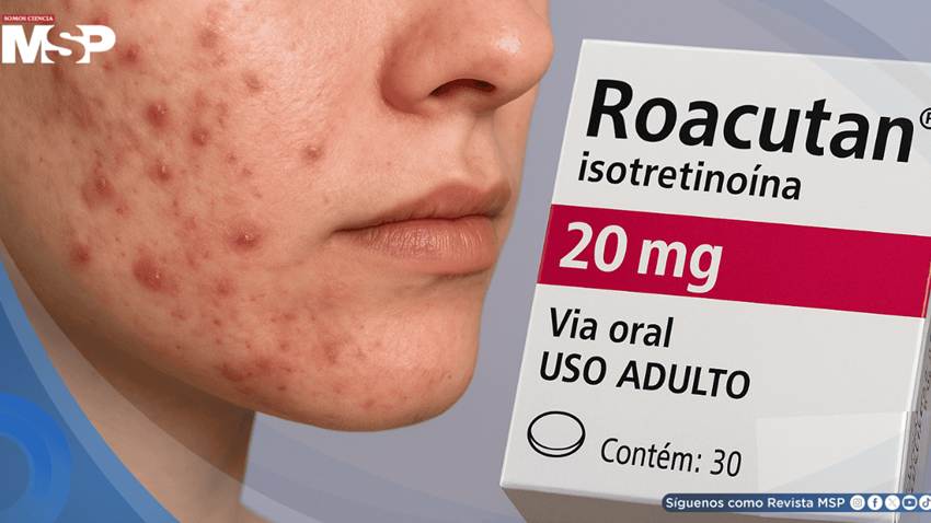 ¿Roacután para el acné severo? Esto es lo que debes saber de automedicarse con Isotretinoína