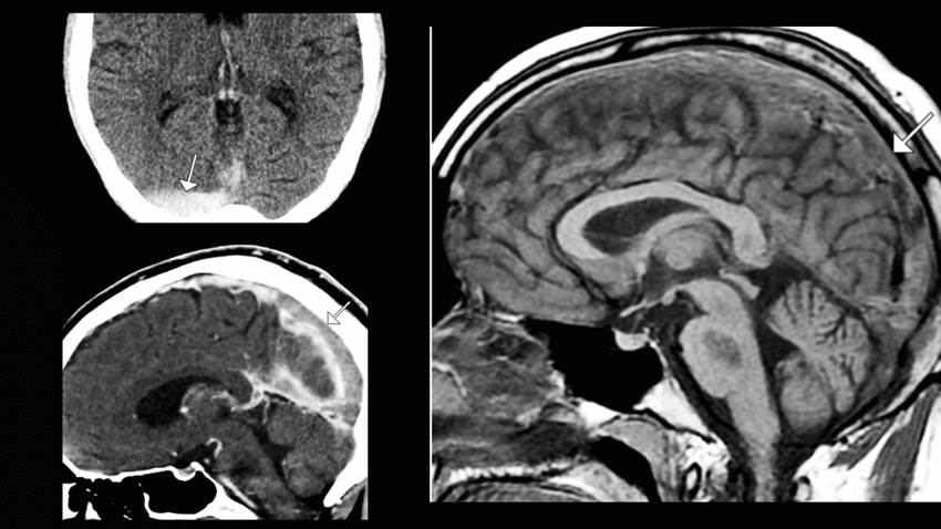 Anticonceptivos orales inducen trombosis venosa cerebral: Cefalea persistente como signo inicial