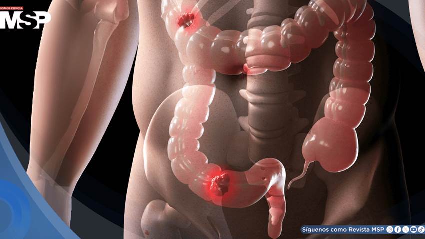 Los riesgos del cáncer colorrectal temprano podrían acumularse desde la infancia, según estudio