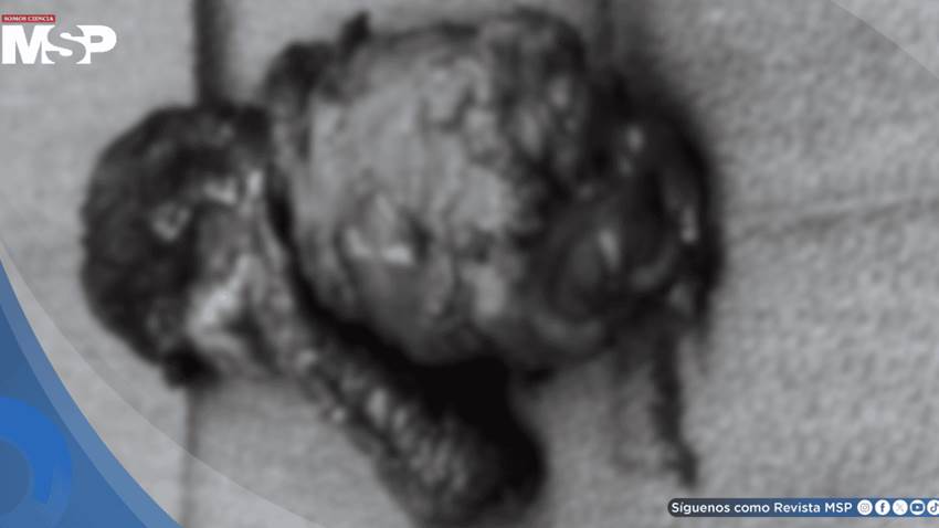 Hombre con diabetes y fallo renal desarrolla gangrena genital tras cirugía por calcifilaxis