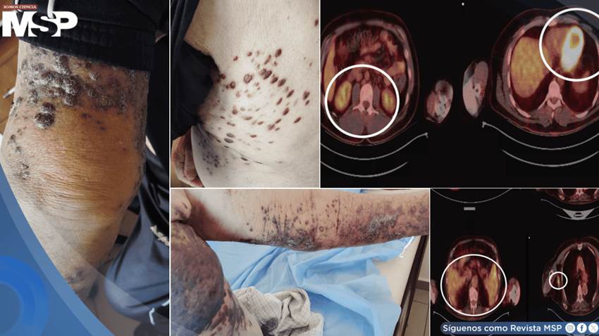 Detectan 3 tipos distintos de cáncer cutáneo en paciente de 83 años con problemas cardiacos