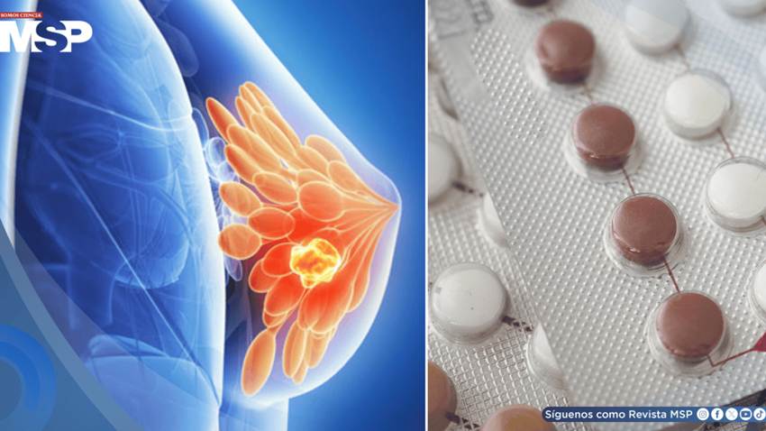 Algunos anticonceptivos hormonales podrían aumentar el riesgo de cáncer de mama: Estudio