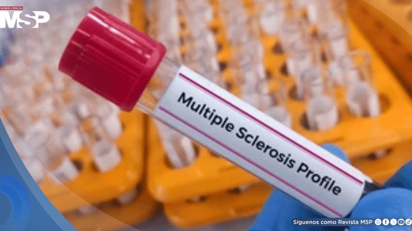 Nuevo test de sangre podría detectar esclerosis múltiple antes de los daños neurológicos
