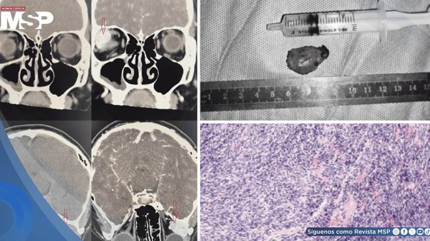 Visión doble reveló un condrosarcoma orbitario inicialmente confundido con hemangioma cavernoso