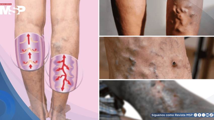 Úlceras varicosas: ¿Qué son, por qué aparecen y cuál es su manejo?
